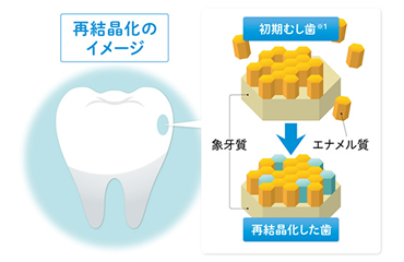 初期虫歯を再結晶化
